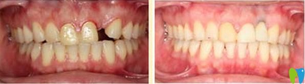 拜博口腔單顆牙缺失種植效果對(duì)比
