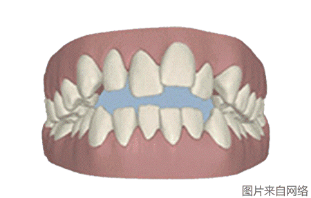 戴隱形雙模牙套牙齒動圖