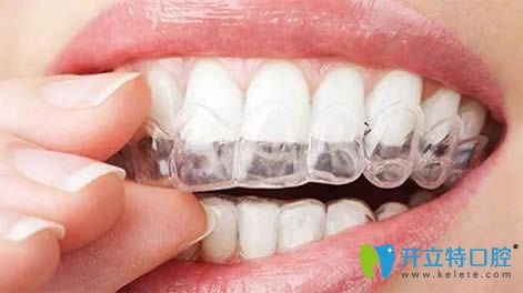 分析:國產(chǎn)隱形牙套品牌中時代天使與達(dá)芬奇隱形矯正哪種好?