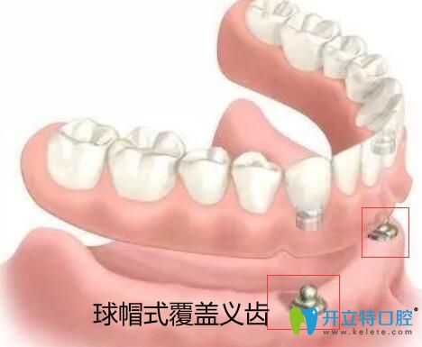 價格吊打種植牙的全口覆蓋義齒修復到底有哪些優(yōu)缺點？