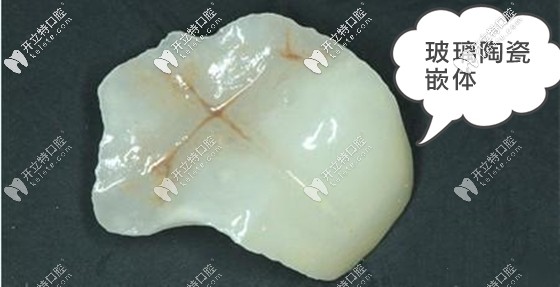 從玻璃陶瓷嵌體的優(yōu)缺點(diǎn)和價(jià)格來分析這個(gè)牙嵌體怎么樣?