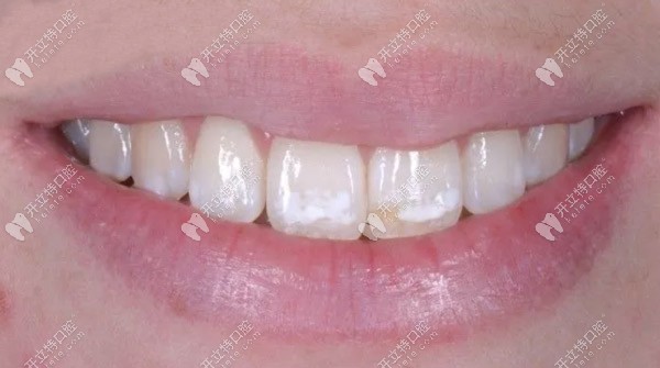 滲透樹(shù)脂治療氟斑牙的效果怎么樣，請(qǐng)看案例