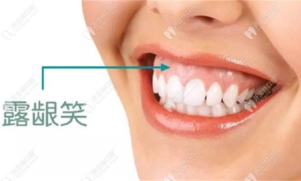 打骨釘可以有效改善露齦笑這我知道,但會不會反彈呢？